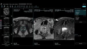 How to read prostate MRI